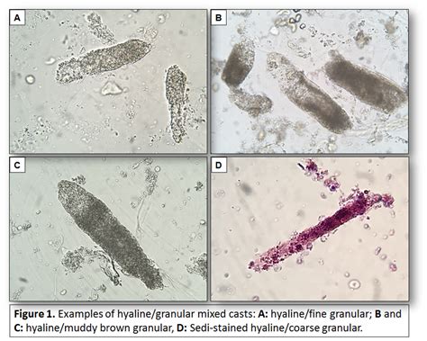 Urine Sediment of the Month: Mixed, Acellular Casts - Renal Fellow Network