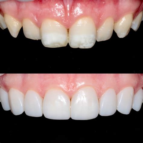 Composite Veneers - Dr James Dentith