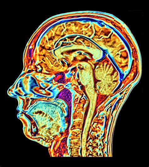 Mri Scan Of Normal Brain Photograph By Alfred Pasieka Science Photo Library | My XXX Hot Girl