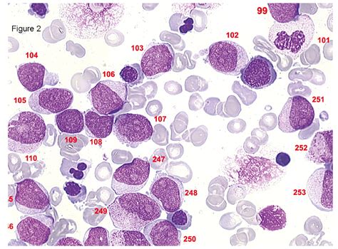 Diagnosis and classification of myelodysplastic syndrome: International Working Group on ...