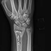 Wrist Open Reduction & Internal Fixation Oklahoma City | Wrist Fractures Edmond, Norman, OK