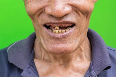 Vieil Homme Souriant Montrant Ses Dents Sans Attrait Sur Le Fond Vert ...