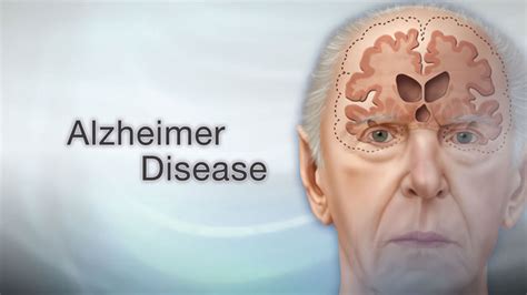 15 Warning Signs Of Alzheimer's Disease- Watch Out For These Symptoms ...