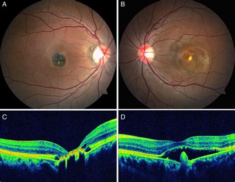 Macular congenital hypertrophy of retinal pigment epithelium (CHRPE) in a patient with best ...