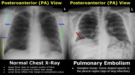 Normal Chest X Ray Vs Pneumonia