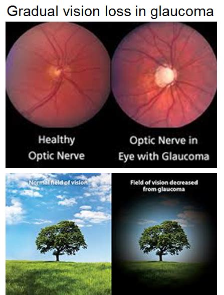 Glaucoma vs. Cataracts — View Optometry | Optometrist in North Vancouver