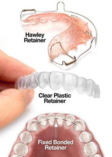 Understanding Retainers After Braces | Dental retainer, Orthodontics, Dental