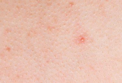 Bumps On Skin That Dont Itch