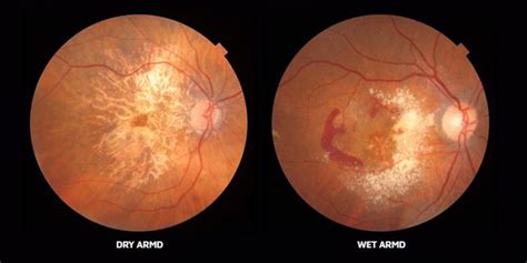 Macular Degeneration Symptoms, Causes, and Treatment