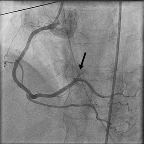 Fig. 19.11, [RCA after stent placement. A...]. - Primary Angioplasty ...