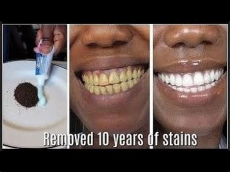 In TWO MINUTES remove 10 YEARS of stains from TEETH!! Results will Shock You - YouTube