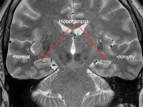 Hippocampal Sclerosis Causes Symptoms Diagnosis Treat - vrogue.co