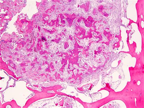 Osteoid Osteoma Histology