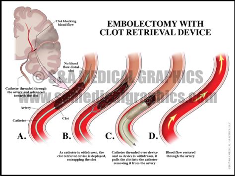 Neurosurgical Complications - S&A Medical Graphics