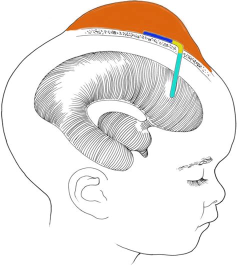 Schematic drawing of a child with a VSG. Note the hydrocephalus,... | Download Scientific Diagram