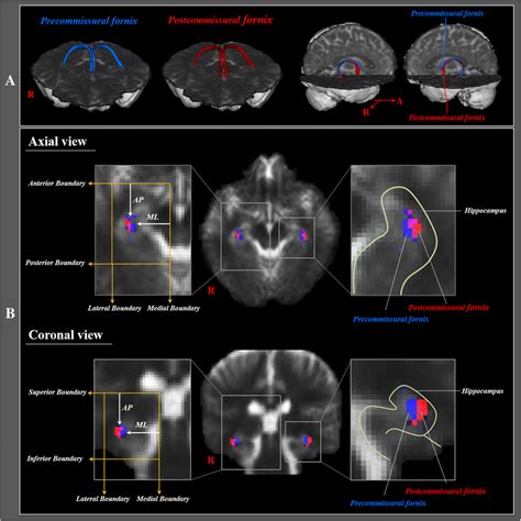 a Precommissural fornix (blue) and postcommissural fornix (red) were ...