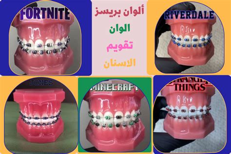 ألوان بريسز الوان تقويم الاسنان | تعرف على كيفية اختيار أفضل لون بريسز للأسنان