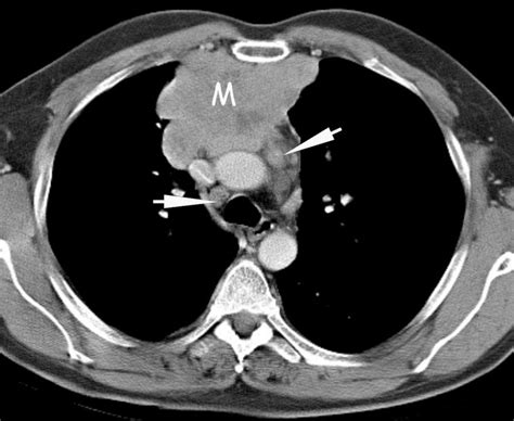 Mediastinal Lymph Nodes Ct Scan