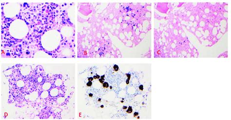 What Is Lambda Light Chain Multiple Myeloma Cells | Americanwarmoms.org