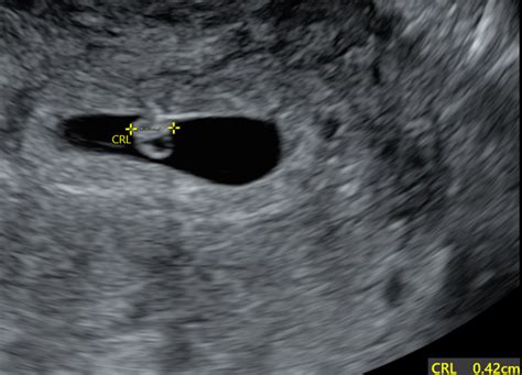 Understanding how 4 abnormal ultrasound findings relate to miscarriage ...