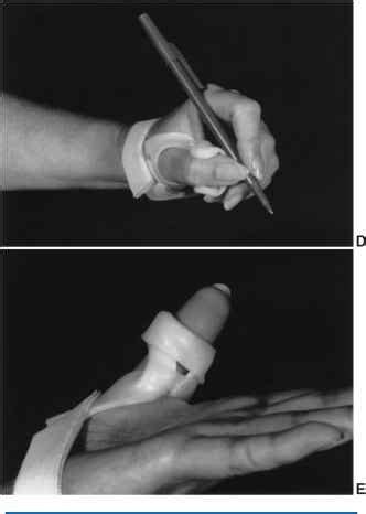 Thumb IP Splints - Extremity Splinting - Mitch Medical Healthcare