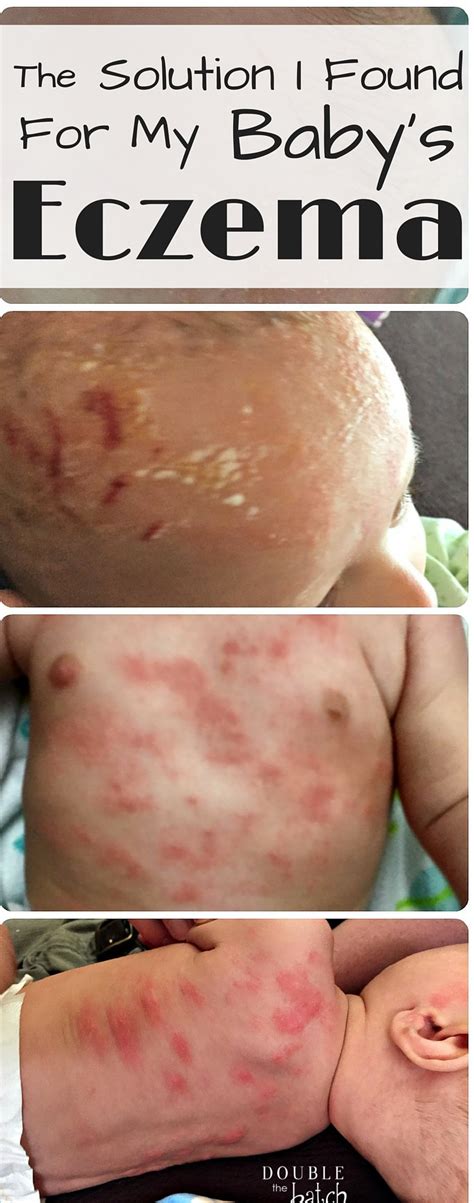 Eczema on Babies: What We did for my Infant's Eczema That WORKED! - Uplifting Mayhem