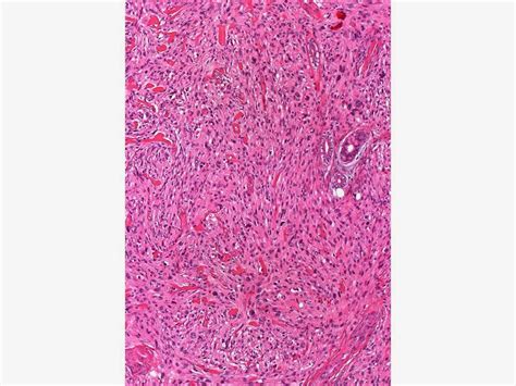 Dermpath Made Simple - Neoplastic: Atypical Fibroxanthoma