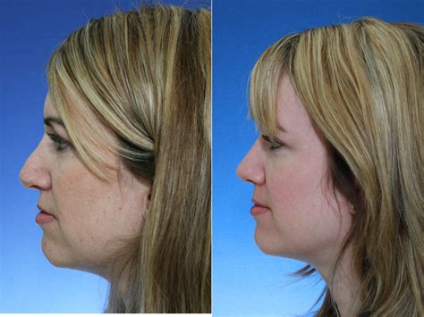 Revision Rhinoplasty Before and After Photos