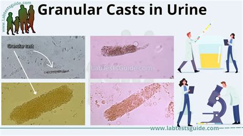 Granular Casts: Definition, Types, Causes, and Clinical Significance