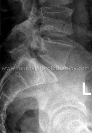 The Resolution of Grade I Lumbar Retrolisthesis with Prolotherapy: A ...