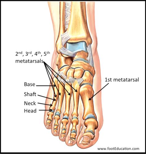 Pin on Metatarsal Pain