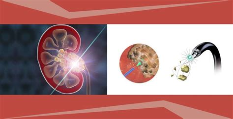 You Should Know about Laser Treatment for Kidney Stones