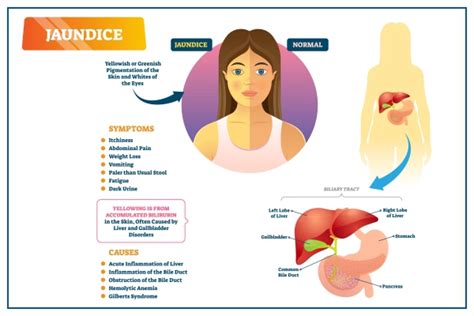 Jaundice: Symptoms, Causes, Diagnosis, Treatment