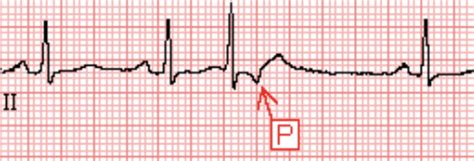 Premature Junctional Complex - ECG Made Simple