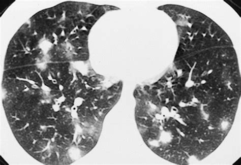 Ascaris Larvae In Lung