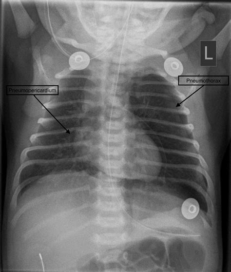 Term neonate with pneumopericardium, pneumothorax while on nasal continuous positive airway ...