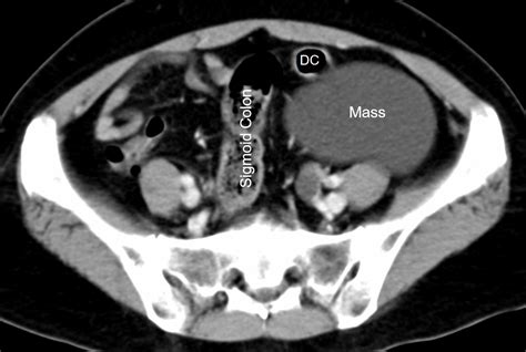 Mesenteric cyst – Radiology Cases