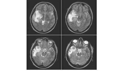 MRI scan of a gliosarcoma, WHO grade IV, in the right temporal lobe ...