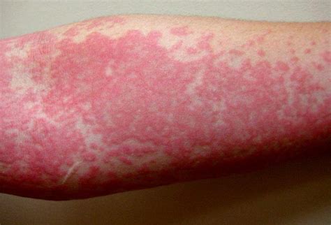 Urticaria - Dr. John KC