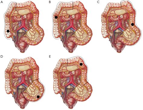 Diagnosis and management of acute complications in patients with colon cancer: bleeding ...