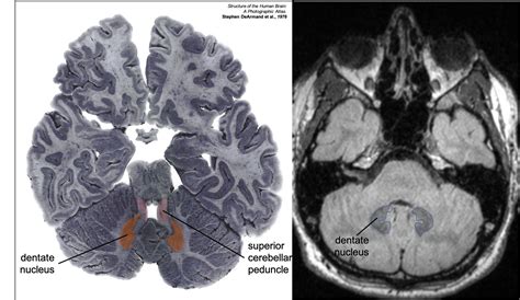 Dentate Nucleus Mri