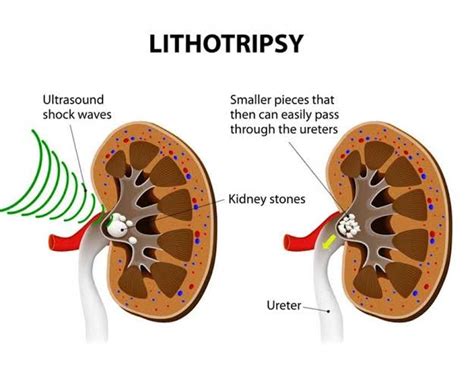 Laser Lithotripsy