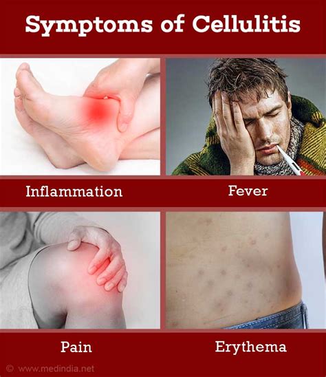 Cellulitis - Causes Symptoms Diagnosis Treatment How to Avoid