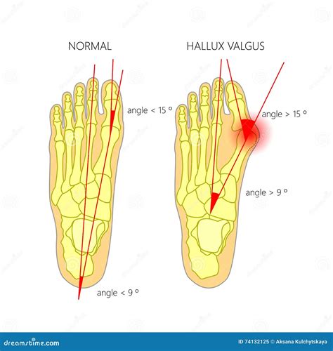 Normal Foot and Valgus Deviation of the First Toe with Indicating of the Deflection Angles Stock ...