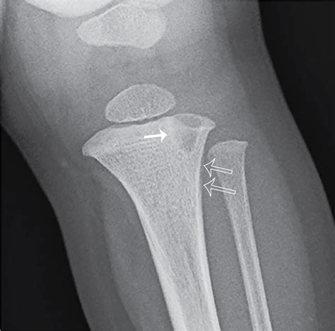 Who’s Brodie? Brodie abscess | Radiology Key