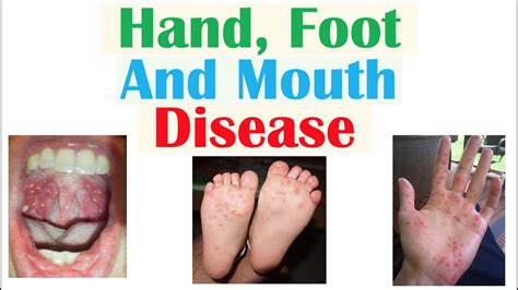 Hand, Foot and Mouth Disease | Viruses, Pathophysiology, Signs and ...