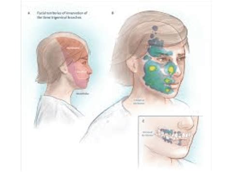 Atypical Facial Pain Treatment/ Specialist Pune- Dr Deshmukh's Pain ...