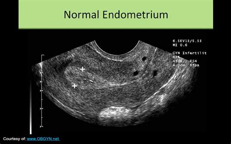 Endometrial cancer Vs Endometriosis