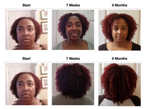 38+ hair growth before and after 6 months - OgdenAlia