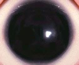 Aniridia - American Association for Pediatric Ophthalmology and Strabismus